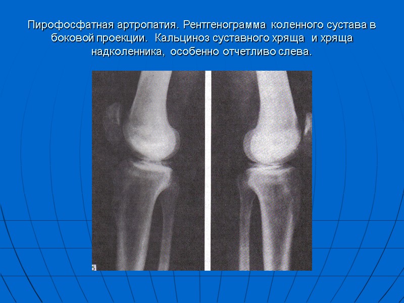 Пирофосфатная артропатия. Рентгенограмма коленного сустава в боковой проекции.  Кальциноз суставного хряща  и